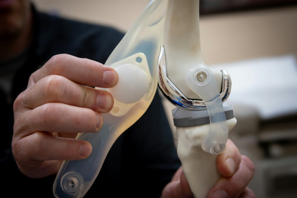 Knee Replacement Surgery: Who Needs It and What to Expect